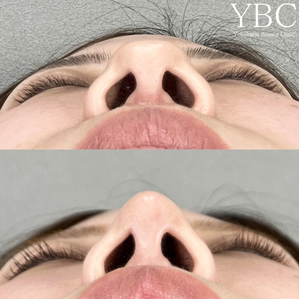 YBC式鼻尖形成・YBC式鼻先シャープ術