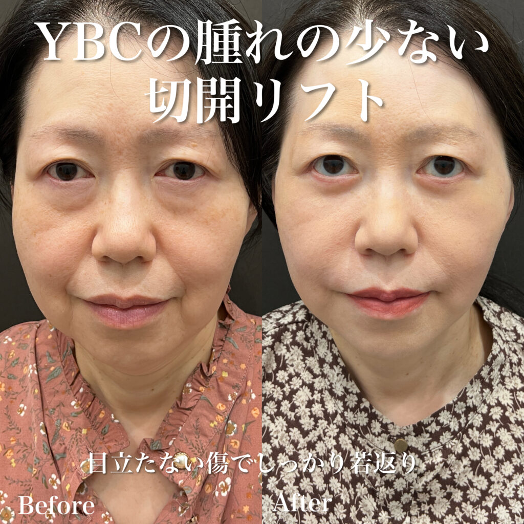 フェイスリフトとネックリフト