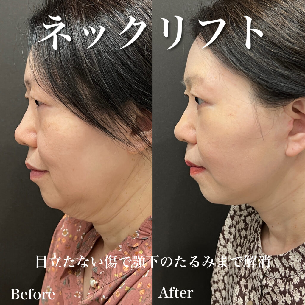 フェイスリフトとネックリフト