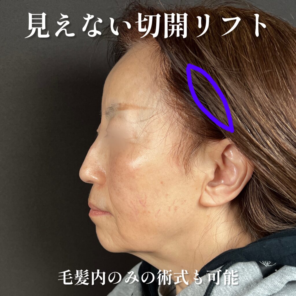 傷の見えない切開リフト