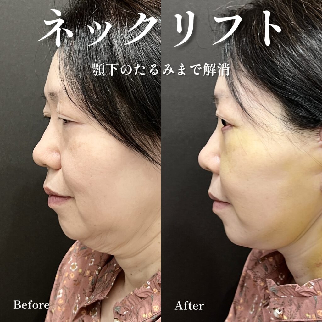 ネックリフトとフェイスリフト