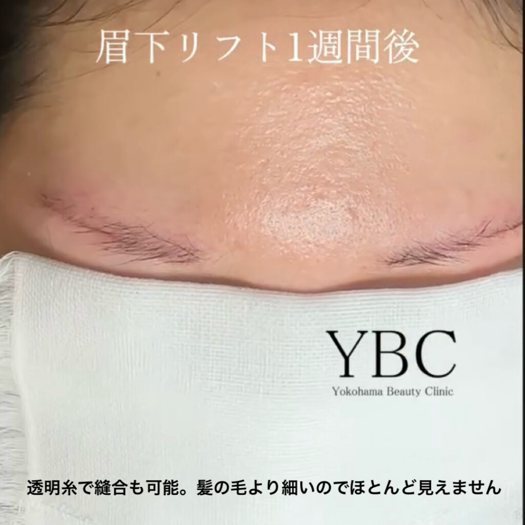 眉下切開リフト