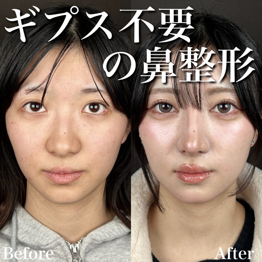 プロテーゼ・鼻尖形成・耳介軟骨移植