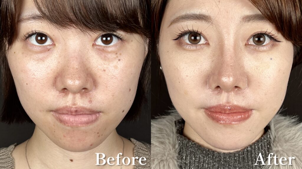 プロテーゼ・鼻尖形成・鼻先シャープ術