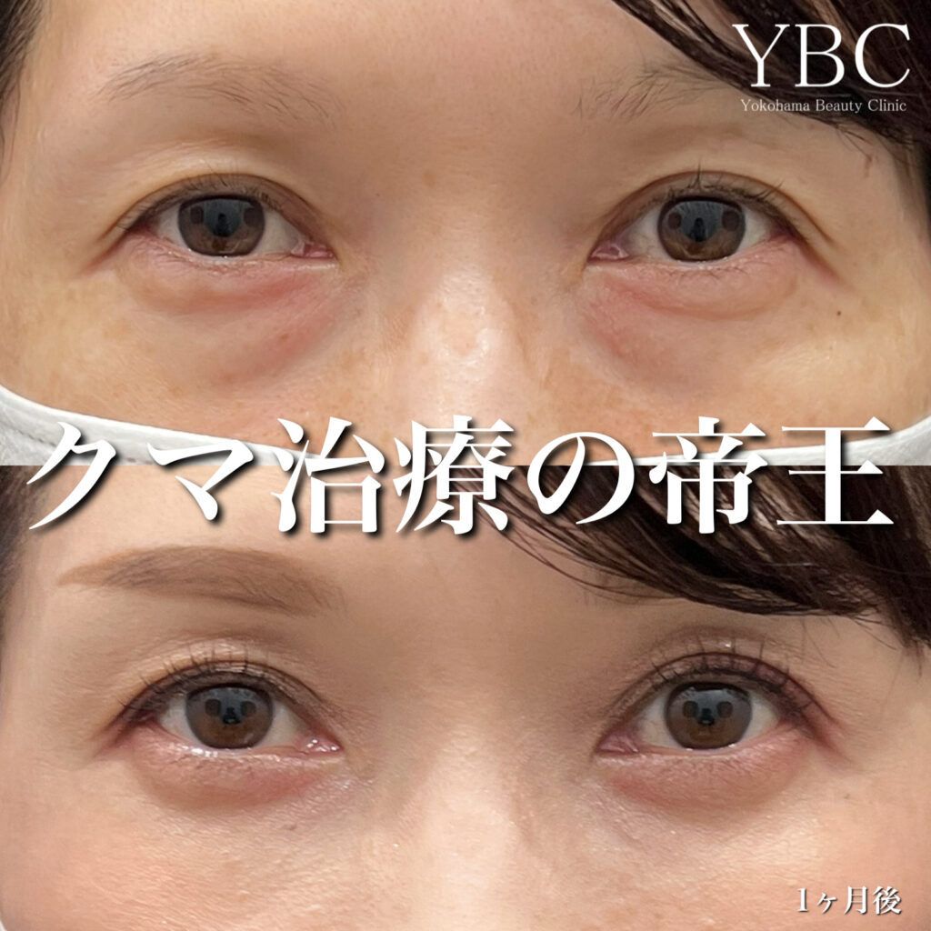 50代クマ治療
