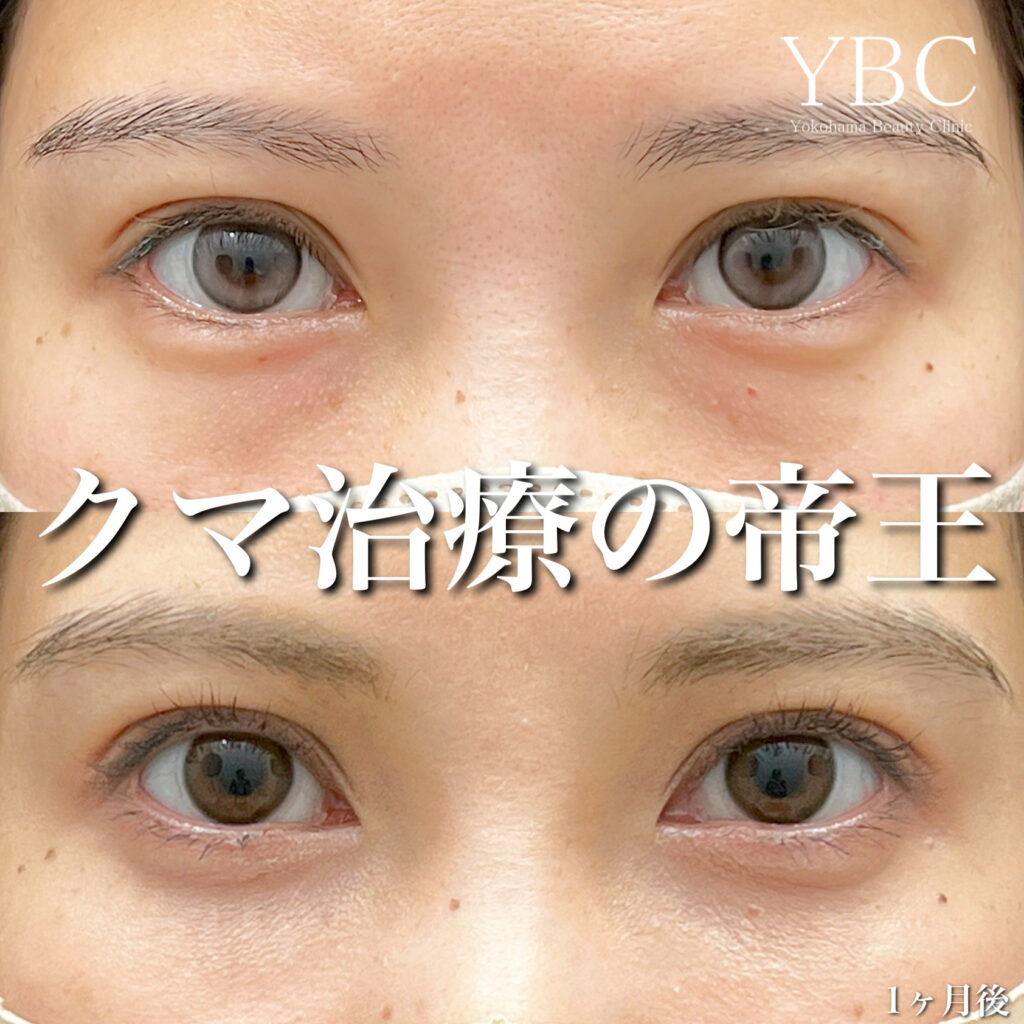 20代クマ治療女性