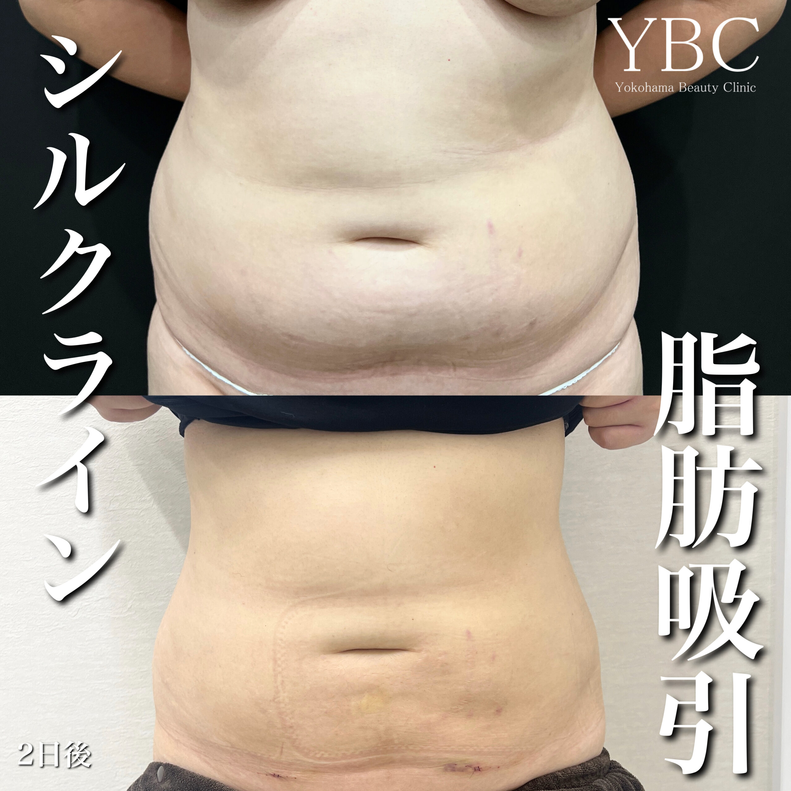 お腹のシルクライン脂肪吸引の症例写真